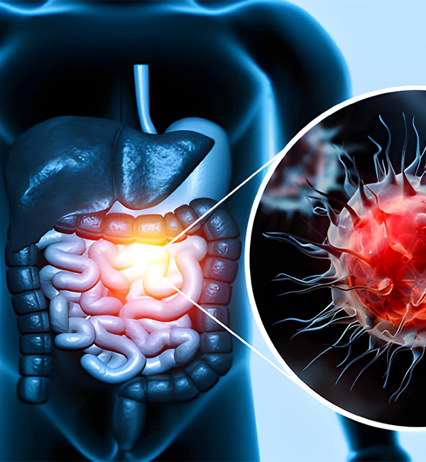 Colorectal Cancer Causes